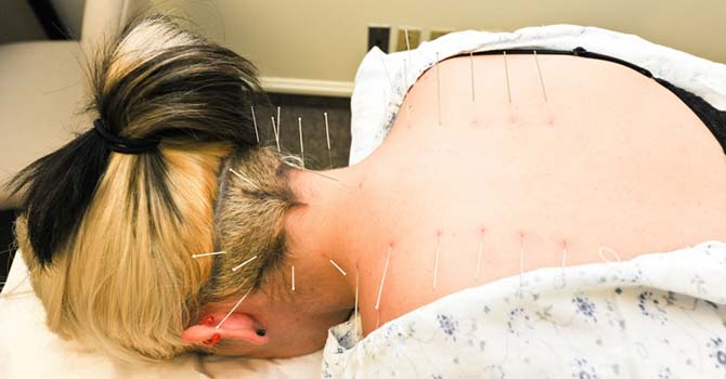 Acupunctuur behandeling