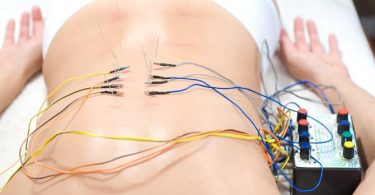 Electro Acupunctuur