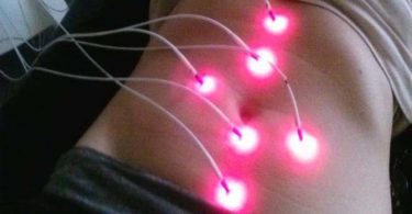 Lazer Behandeling