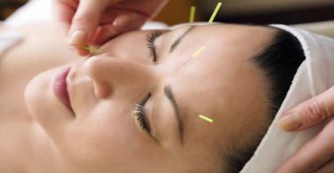 Acupunctuur Behandeling