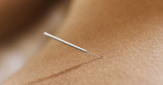 Acupunctuur Naald
