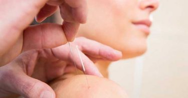 Schouder Acupunctuur