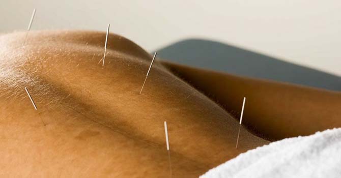 Acupunctuur Naalden In Je Rug